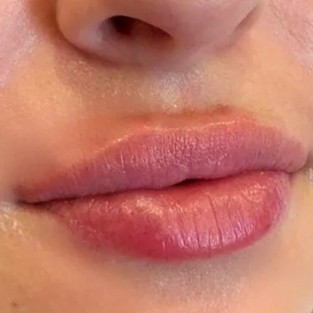 Lippen nach einer Hyaluron-Unterspritzung bei Vitamoure