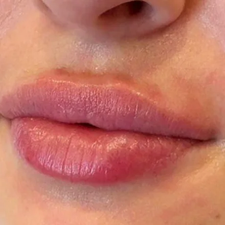 Lippen mit mehr Volumen und klarer Kontur nach der Unterspritzung