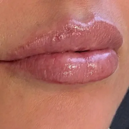 Natürlich wirkende Lippen nach der Unterspritzung