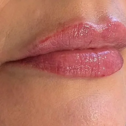 Gleichmäßig aufgebaute Lippen nach der Hyaluron-Unterspritzung