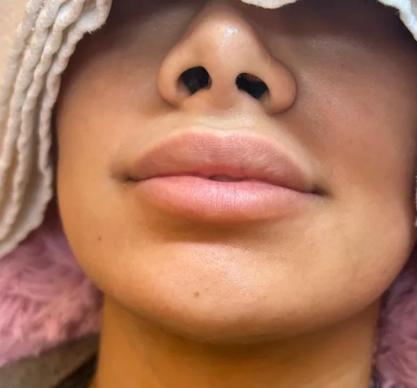 Lippen direkt nach einer Hyaluron-Unterspritzung bei Vitamoure in Köln