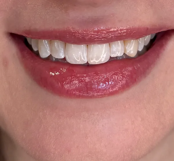 Dasselbe Lächeln nach dem Premium Bleaching bei Vitamoure