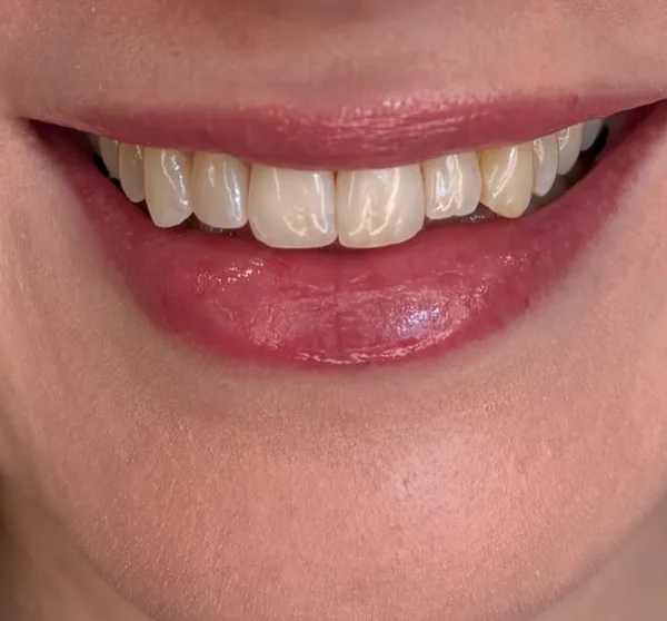 Lächeln vor dem kosmetischen Zahnbleaching